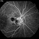 Optic Nerve Pit Optic Nerve Pit